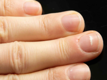 Wat zijn strepen op je nagel en wat kun je er (zelf) tegen doen?